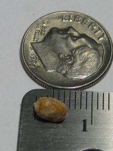 A kidney stone about a half-inch in diameter next to a ruler and a 25-cent coin for reference.