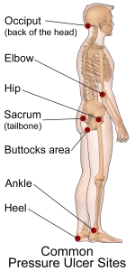 A person with common pressure ulcer sits labeled.