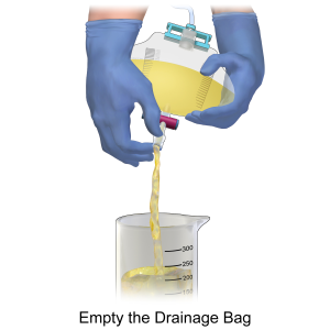 Gloved hands emptying a catheter drainage bag into a graduated cylinder