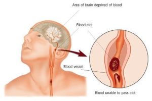 A diagram of a blood vessel in someone's brain that is being blocked, stopping blood flow and causing brain damage.